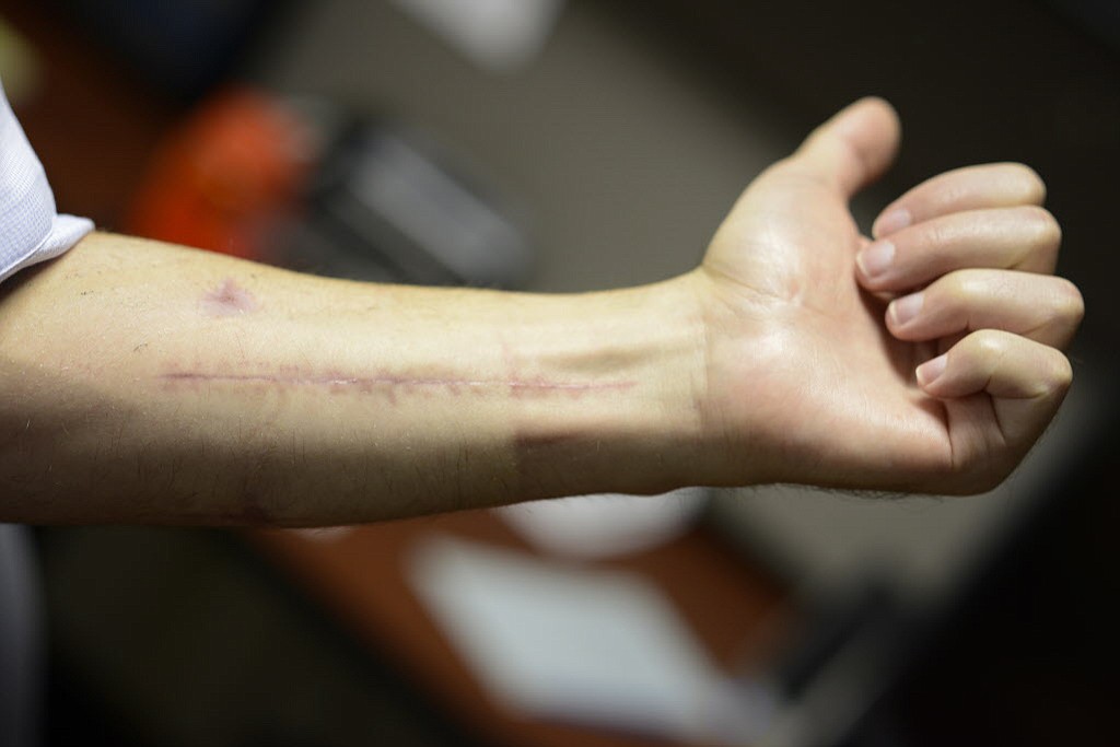Scars on Officer Dustin Goudschaal's arm reveal the severity of the injuries he sustained when he was shot on June 30, 2014.