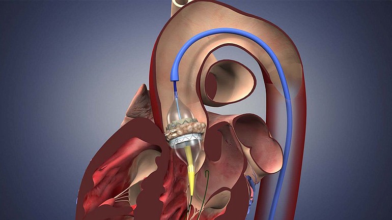 The Edwards SAPIEN valve is part of a long-awaited study that suggests many people with bad aortic valves can have them replaced through a tube into an artery instead of open-heart surgery. Edwards Lifesciences Corp.