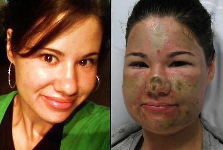 Bethany Storro before and after the acid incident.