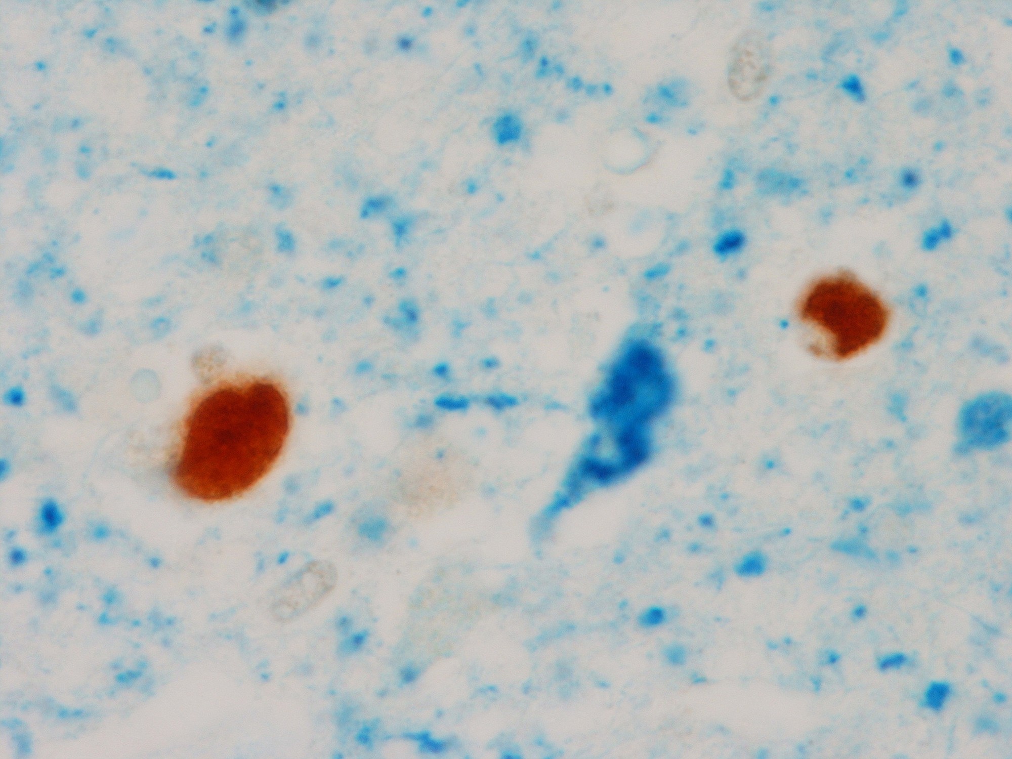 An abnormal TDP-43, the two circular brown blobs, in the brain of a patient with tau neurofibrillary tangle, blue flame shape blob in the middle, and Alzheimeru2019s disease during the pathological analyses in Rochester, Minn.