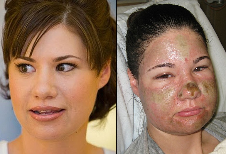 Bethany Storro before and after her self-inflicted facial injuries.