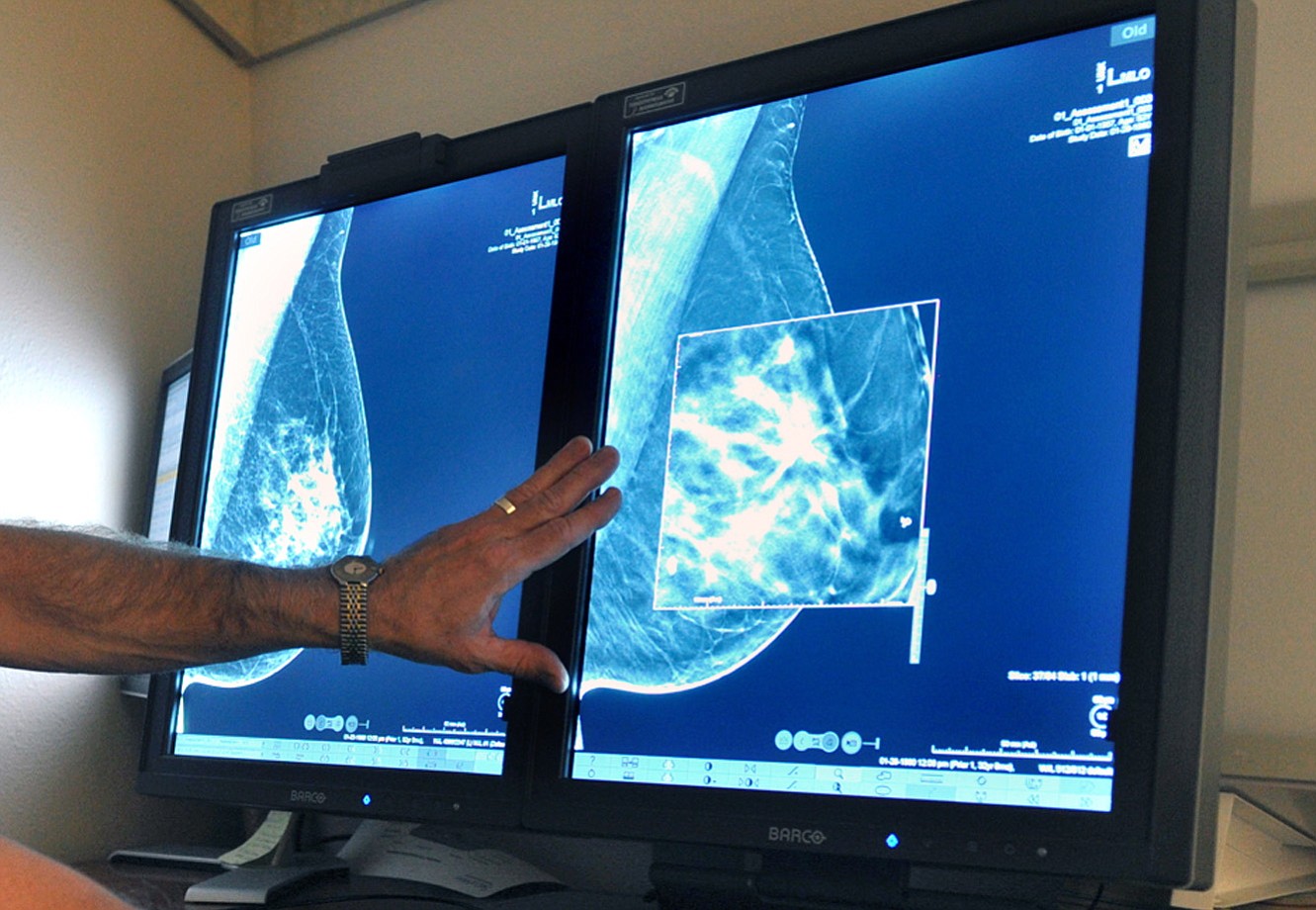A radiologist compares an image from earlier, 2-D technology mammogram to the new 3-D Digital Breast Tomosynthesis mammography in Wichita Falls, Texas.