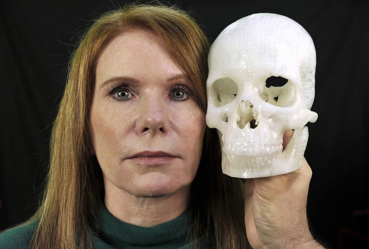 A 3-D printer model of Pamela Shavaun Scott's skull is held up to her face after her brain tumor was removed from behind her eye by entering through the crease of her eyelid.