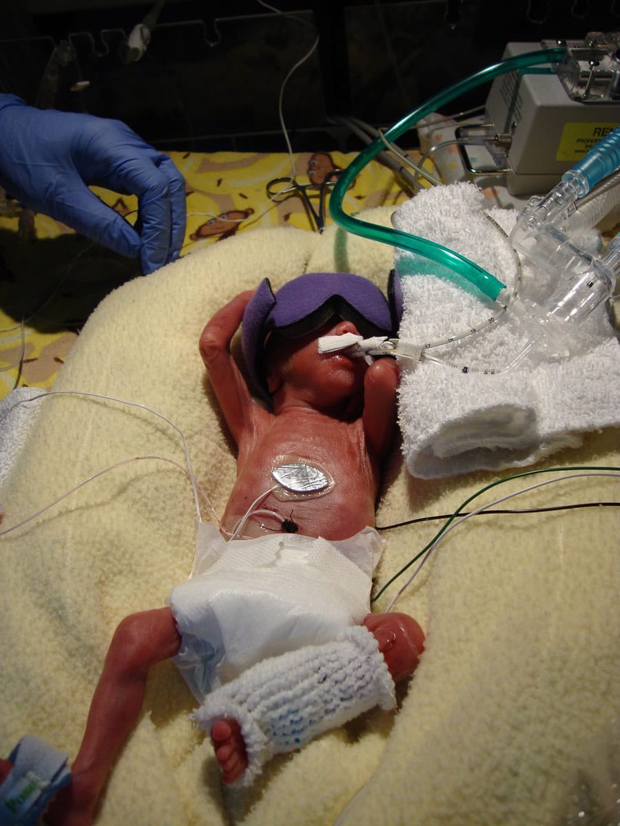 Dexter Brady is shown Sept. 11, 2009, at 3 days old. Dexter was born about 16 weeks early, attached to a ventilator and feeding tubes under warming lights in the neonatal intensive care unit at the University of Iowa Children's Hospital in Iowa CIty, Iowa.