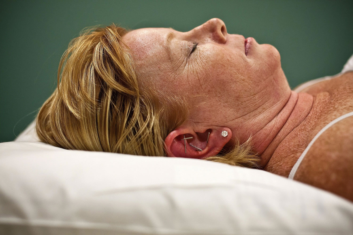 Kim Ricci relaxes with acupuncture needles in her ear while receiving a treatment at The Gynecologic Cancer Center in Orlando in May.