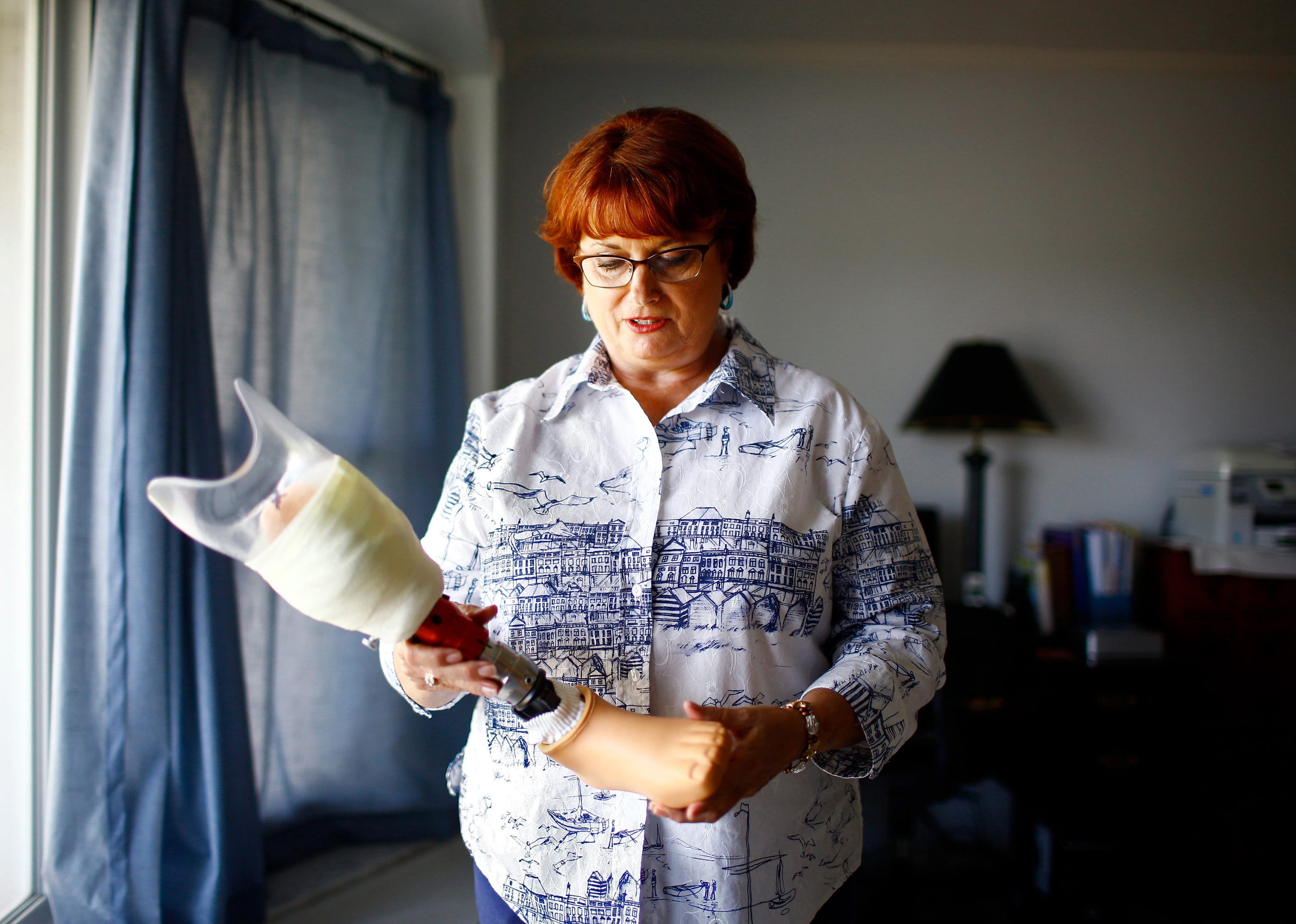 Army veteran Brenda Reed, 59, of Tierra Verde, Fla., has not been able to be successfully fitted with a woman's prosthetic foot since her left foot was amputated in 2013.   She underwent three failed surgeries to correct the damage from a severe break in 1983 while serving in the Army.