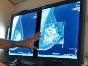 Aradiologist compares an image from earlier, 2-D technology mammogram to the new 3-D Digital Breast Tomosynthesis mammography in Wichita Falls, Texas.