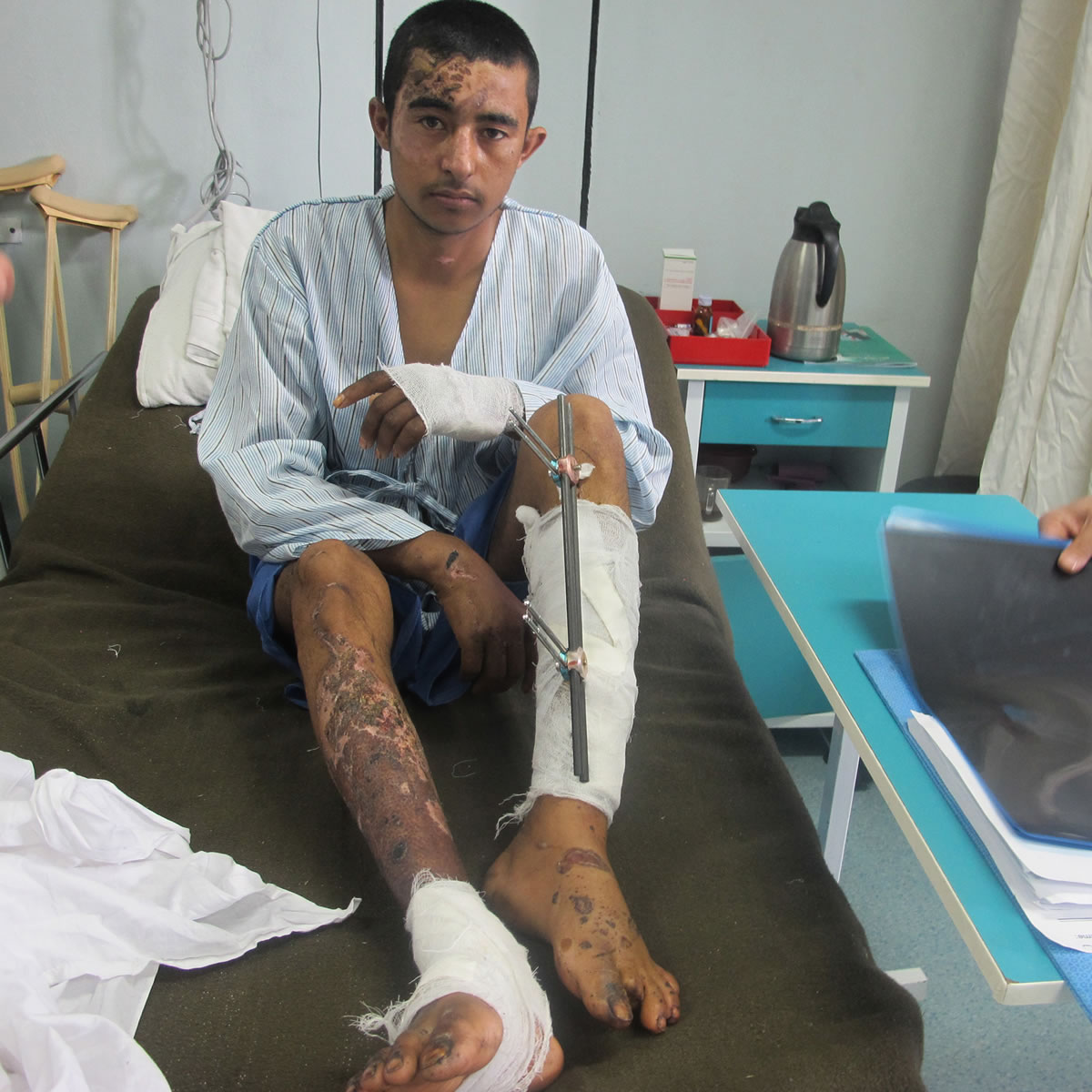 Khal Nazar Aziz, an Afghan police officer who was injured by an IED, or improvised explosive device, recovers on Feb. 12 in a military hospital in Mazar-e-Sharif, Afghanistan.
