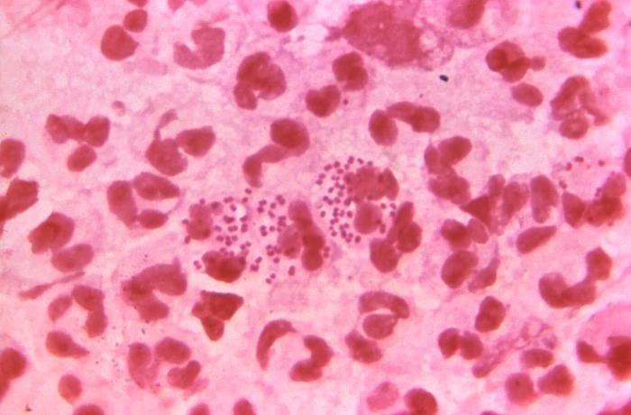 A microscopic view of gonorrhea.