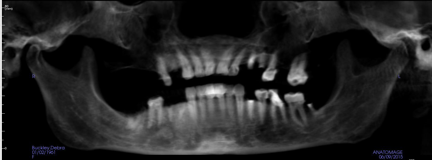 A panoramic X-ray shows the extent of Debra Buckley&#039;s dental needs.