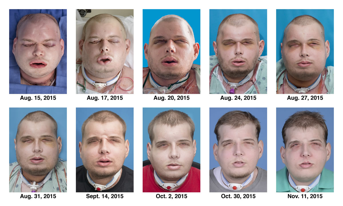 This combination of Aug. 15 to Nov. 11 photos shows the recuperation of Patrick Hardison after his facial transplant surgery in New York. Hardison was burned Sept. 5, 2001, in Senatobia, Miss. A 27-year-old father of three at the time who&#039;d served for seven years as a volunteer firefighter, he entered a burning house to search for a woman. The roof collapsed, giving him third-degree burns on his head, neck and upper torso.