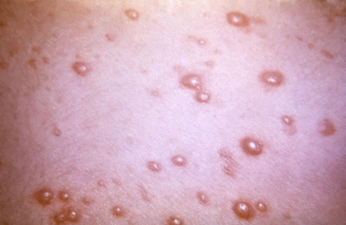 This pustulovesicular rash represents a generalized herpes simplex outbreak due to the Varicella-zoster virus (VZV) pathogen.  The VZV pathogen may lay dormant in the spinal nerve roots through a chickenpox infected individualis life, only manifesting its presence through outbreaks as Shingles, or herpes zoster.