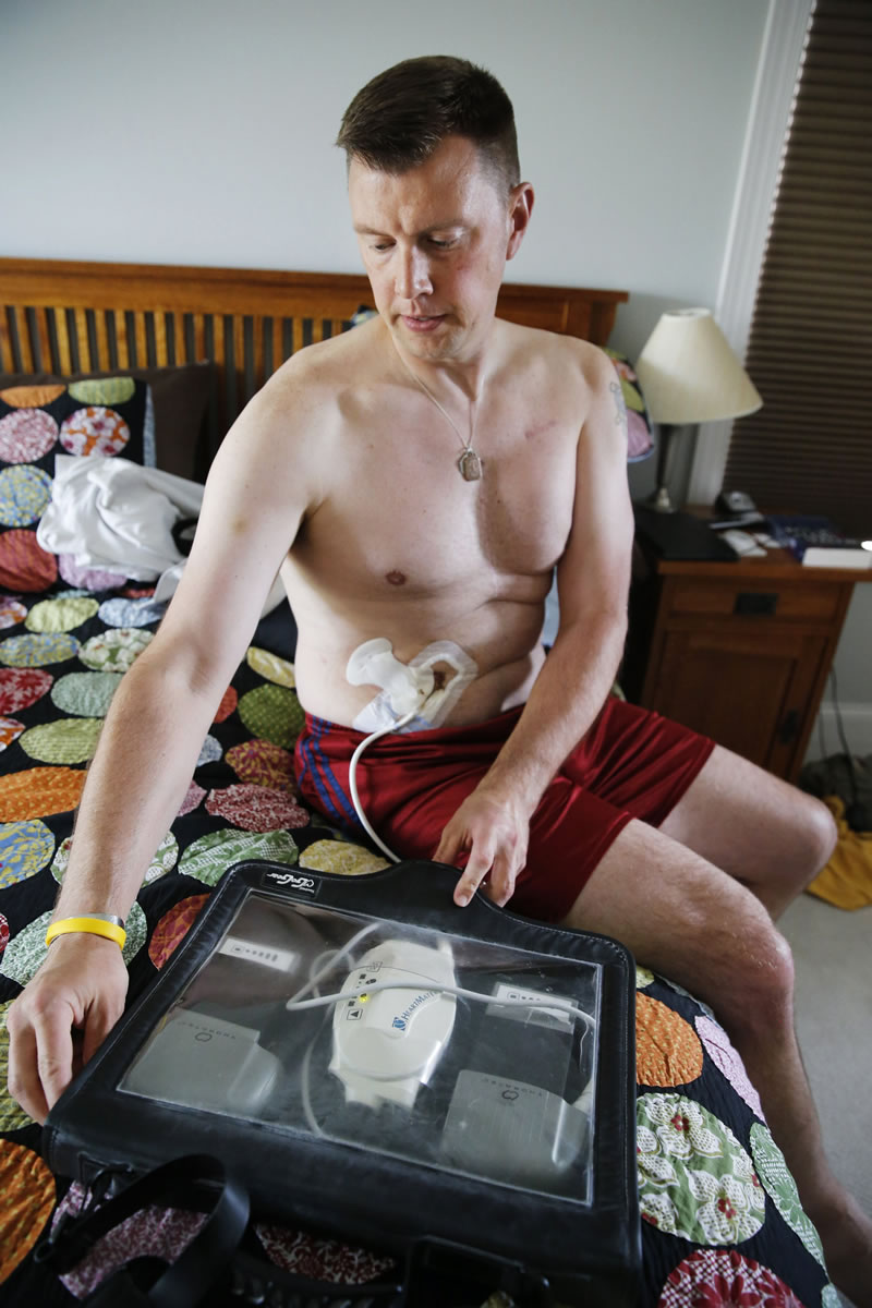 At his home in Plymouth, Minnesota, Peter Quimby must waterproof the batteries and control unit that run his left ventricular assist device, LVAD before he showers July 10.