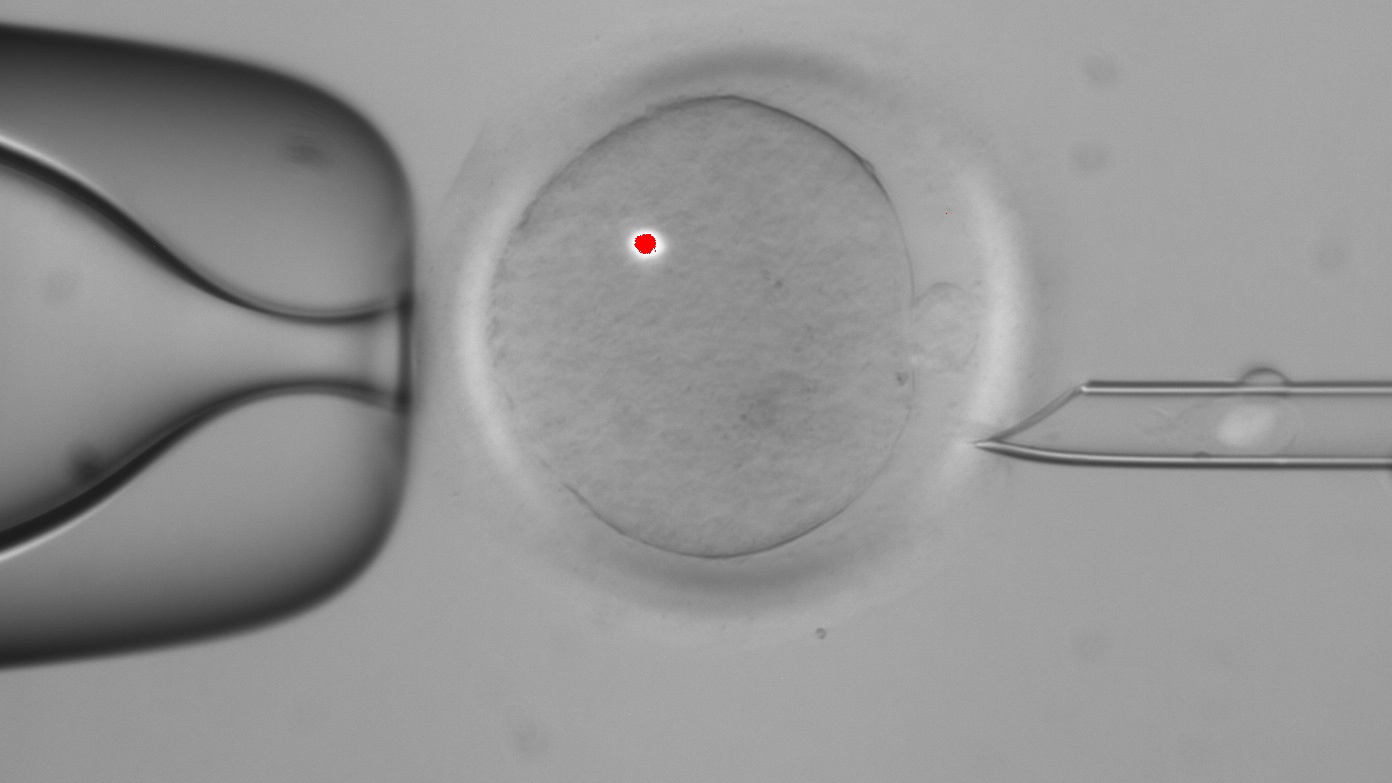 A faint white blotch in the tube at right is DNA that has been removed from a human egg, center. The red dot is from a laser used in the procedure. Scientists have successfully transplanted DNA between human eggs and grown them into early embryos.