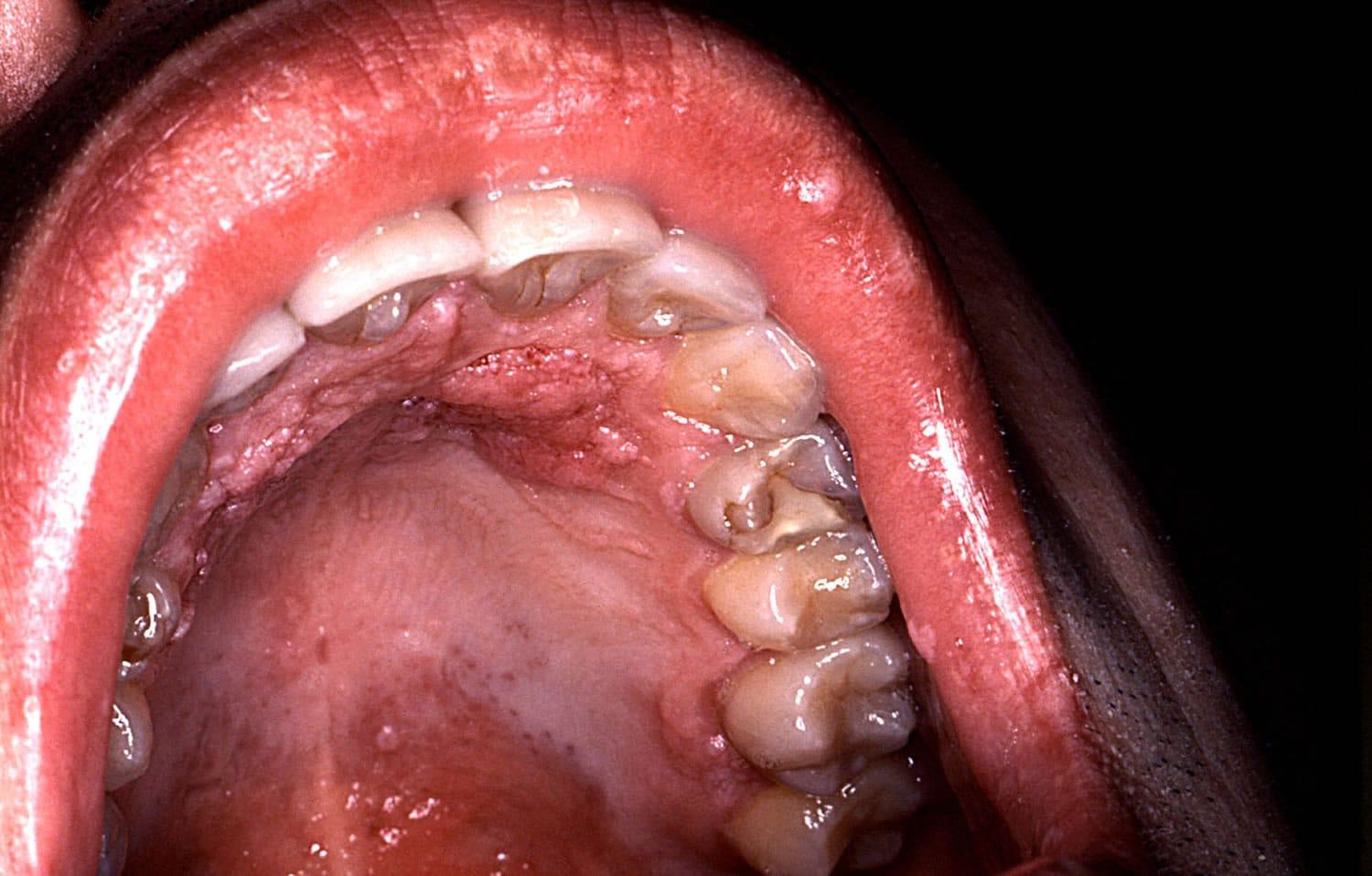 These warts were caused by the human papillomavirus.