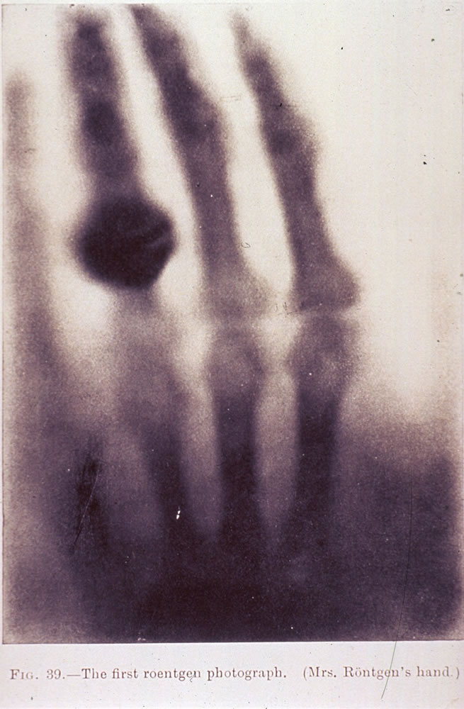 Wilhelm Conrad Rontgen accidentally discovered the X-ray while experimenting with electricity. He made this image of his wife's hand about a week after the discovery on Nov. 8, 1895.