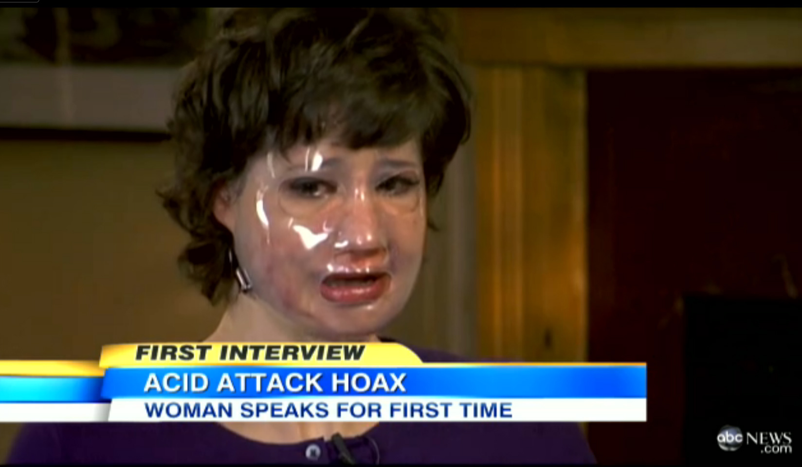 Bethany Storro, 30, of Vancouver wears a clear compression mask during a Monday appearance on &quot;Good Morning America.&quot; She explained why she burned her face with drain cleaner and then, claimed she was attacked.