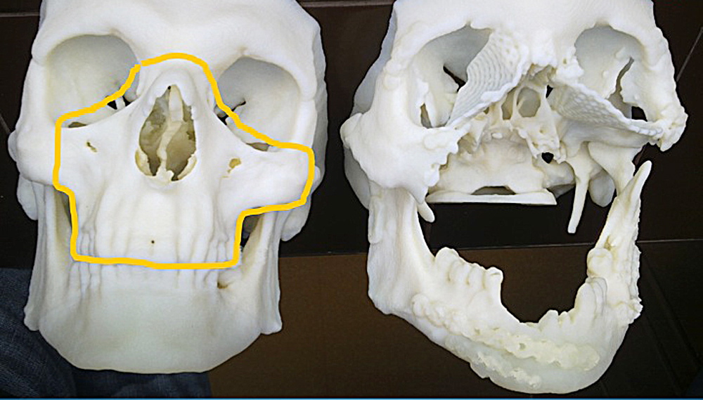 This computerized tomography provided by the Cancer Center and Institute of Oncology in Gliwice, Poland, shows the skull of a 33-year-old Polish man after it was damaged in a work accident, right, alongside the healthy skull of another person.