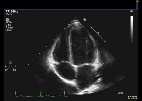 Echocardiogram of a standard teen heart.