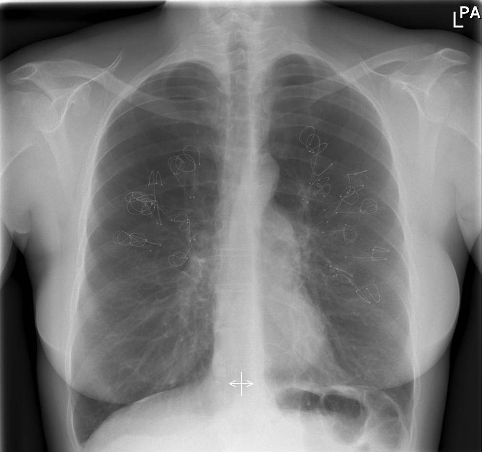 An X-ray shows lungs following the PneumRx endobronchial coil treatment procedure. A minimally invasive way to treat severe breathing problems caused by lung disease showed modest but promising benefits in a small French study.