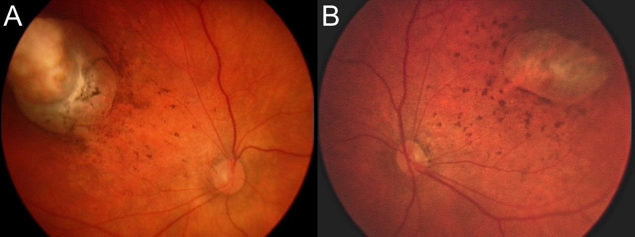 This combination of images shows abnormalities, at upper left and upper right, on the back of the eyes of a 1-month-old boy diagnosed with microcephaly due to a possible congenital Zika infection.