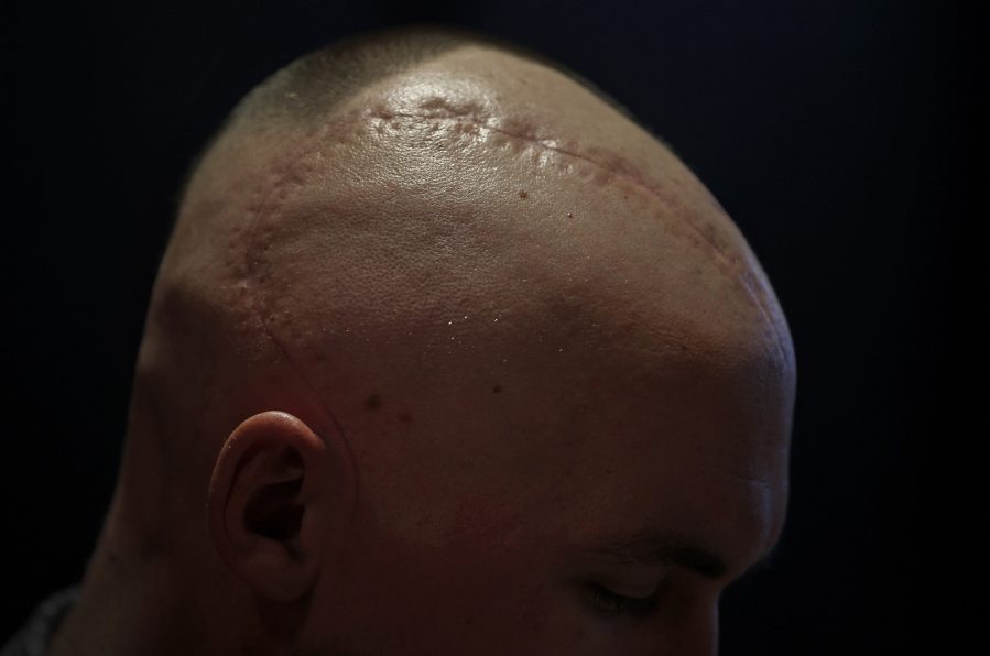 A scar from a brain surgery crosses Chase Sims&#039; head at Prestonwood Baptist Church on April 20 in Plano, Texas. (Jae S.