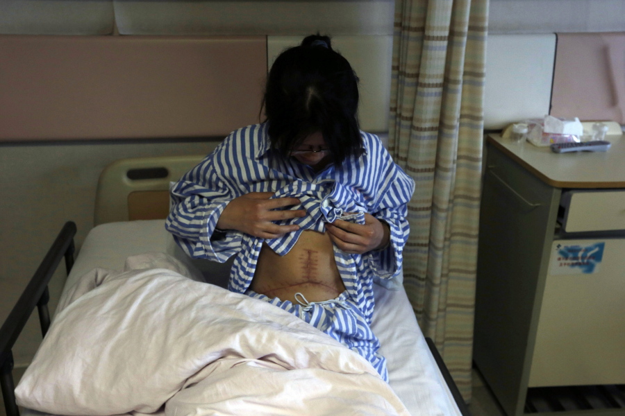 In this 2013 file photo, Fang Hui, 28, shows the scar from a liver transplant operation. She received a portion of her sister&#039;s liver at a hospital in Hangzhou. China. China claims it ended the harvesting of executed inmates&#039; organs for transplants in January 2015.