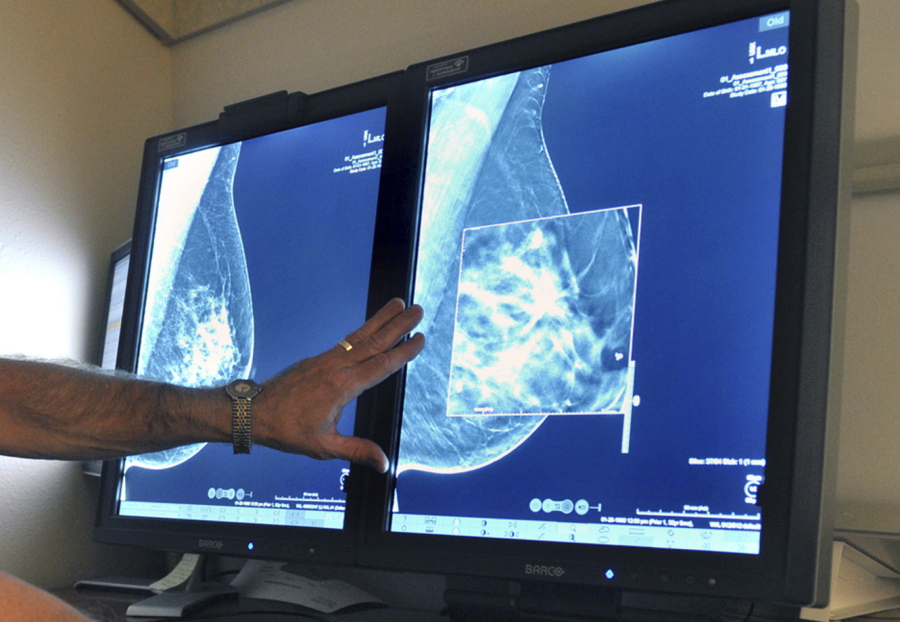 FILE - In this Tuesday, July 31, 2012 file photo, a radiologist compares an image from earlier, 2-D technology mammogram to the new 3-D Digital Breast Tomosynthesis mammography in Wichita Falls, Texas. The technology can detect much smaller cancers earlier. A study released Wednesday, Oct. 12, 2016 questions the value of mammograms for breast cancer screening. It concludes that a woman is more likely to be diagnosed with a tumor that is not destined to become large, and presumably more life-threatening, than she is to have earlier detection of one that is.