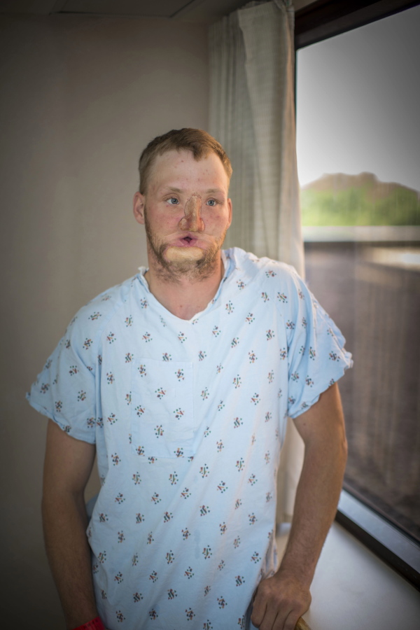 Andy Sandness waits for his face transplant procedure June 10 at the Mayo Clinic in Rochester, Minn. (ERIC M.