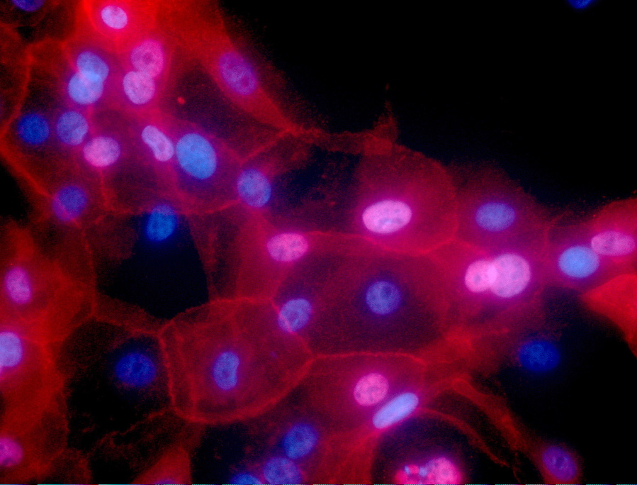 This undated fluorescence-colored microscope image shows a culture of breast cancer cells.