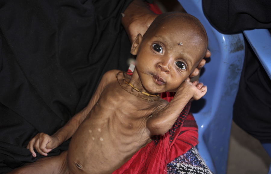 Malnourished 9-month-old Ali Hassan is held by his mother, Fadumo Abdi Ibrahim, on Feb. 25 at a feeding center in Mogadishu, Somalia.