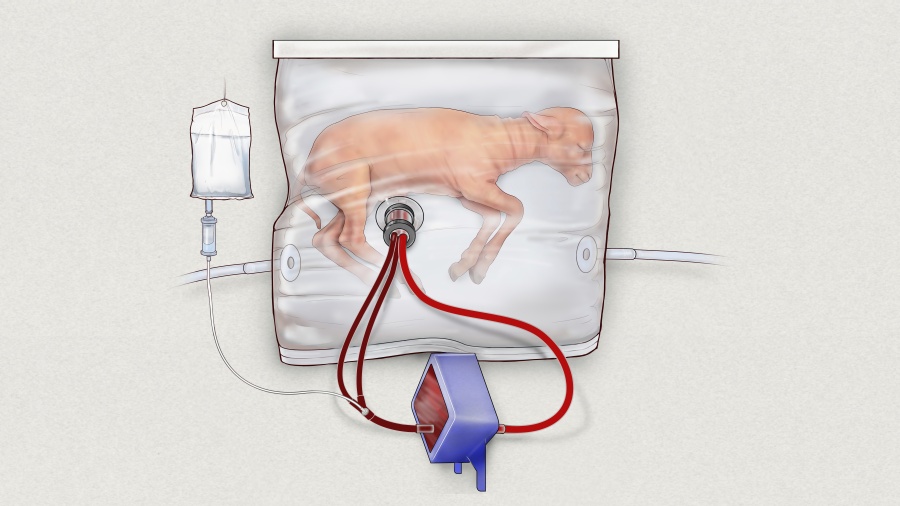 In this drawing provided by the Children???s Hospital of Philadelphia, an illustration of a fluid-filled incubation system that mimics a mother???s womb, in hopes of one day improving survival of extremely premature babies. In animal testing, fetal lambs grew for up to four weeks inside a bag filled with a substitute for amniotic fluid, while the heart pumped blood into a machine attached to the umbilical cord that supplied oxygen like a placenta normally would.