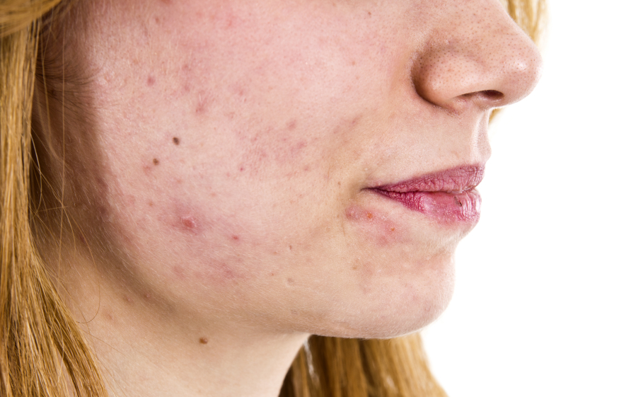 Acne isn’t always limited to adolescence.