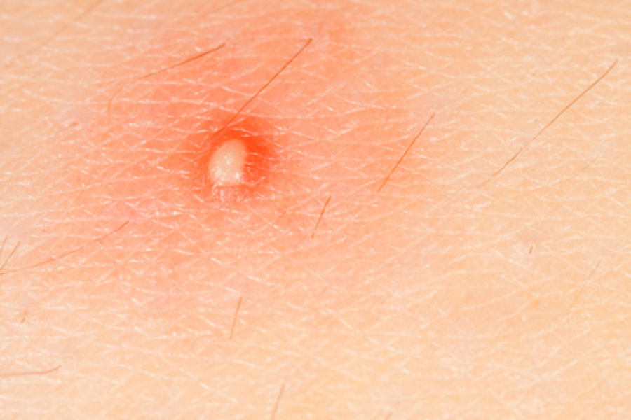 There are simple home remedies for small boils, but never squeeze or lance a boil yourself.