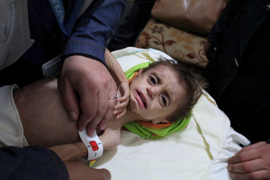 This photo provided on Monday, October 30, 2017 by UN Office for the Coordination of Humanitarian Affairs (OCHA), shows a severely malnourished child at the al-Kahef hospital in Kafr Batna, Eastern Ghouta near Damascus, Syria. Humanitarian officials are warning that conditions outside Syria’s capital have reached crisis levels, as the government refuses to give up a siege against its opponents that has trapped close to 400,000 people without enough food, fuel or medicine for the winter.