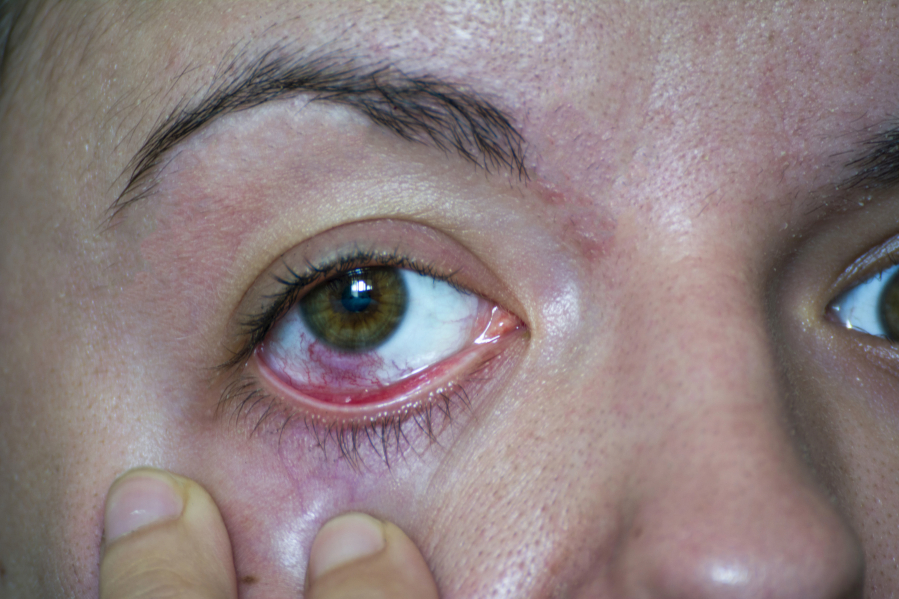 Pink eye, or conjunctivitis, is an inflammation or infection of the transparent membrane that lines your eyelid and covers the white part of your eyeball.