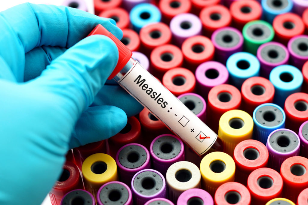 State of emergency declared in US measles outbreak