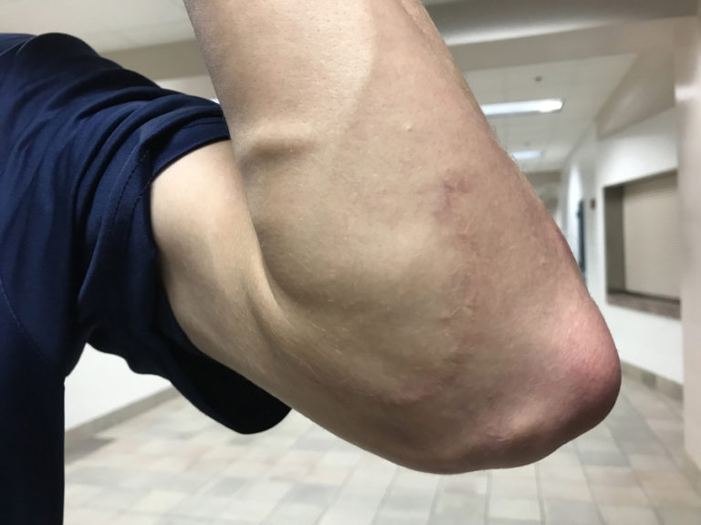 Skyview High School pitcher Lowell Dunmire shows the scar from Tommy John surgery he had in February 2017.