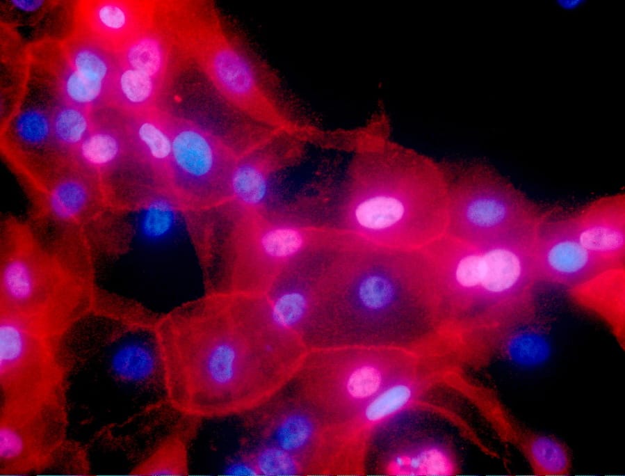 FILE - This undated fluorescence-colored microscope image made available by the National Institutes of Health in September 2016 shows a culture of human breast cancer cells. On Tuesday, Aug. 20, 2019, the U.S. Preventive Services Task Force recommended more women should consider gene testing for hereditary breast or ovarian cancer, especially those who’ve already survived cancer once.