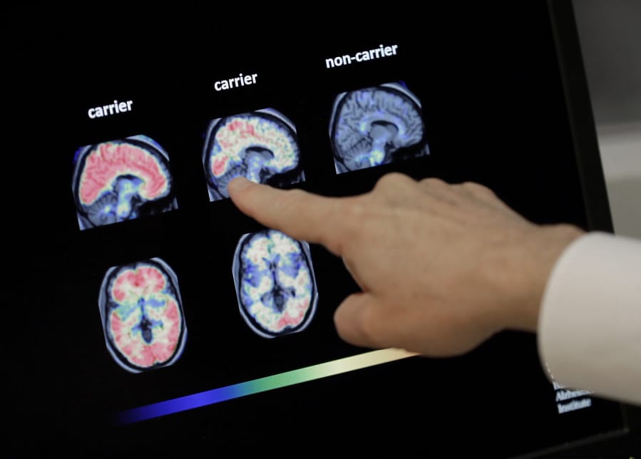 FILE - In this Aug. 14, 2018 file photo, Dr. William Burke goes over a PET brain scan at Banner Alzheimers Institute in Phoenix. The drug company Biogen Inc. says it will seek federal approval for a medicine to treat early Alzheimer&#039;s disease, a landmark step toward finding a treatment that can alter the course of the most common form of dementia.