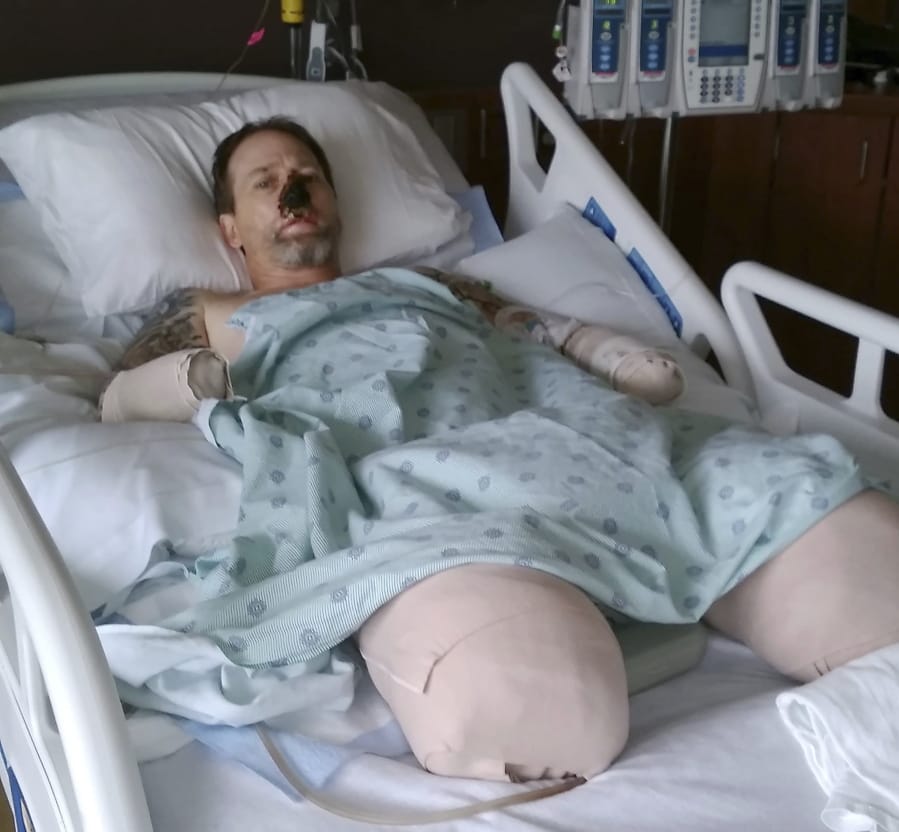 In this Aug. 2, 2018 file photo provided by Dawn Manteufel, Greg Manteufel lays in his hospital bed at Froedtert Hospital in Milwaukee. He lost parts of his arms and legs, as well as the skin of his nose and part of his upper lip from capnocytophaga, a bacteria commonly found in the saliva or cats and dogs which almost never leads to people getting sick, unless the person has a compromised immune system. Manteufel was perfectly healthy when he got sick in June of 2018. Over the last seven years, a team of researchers at Brigham and Women&#039;s Hospital in Boston, connected to Harvard Medical School, have tested other healthy people who were affected and developed a theory on why they were affected- a gene change in all the victims.