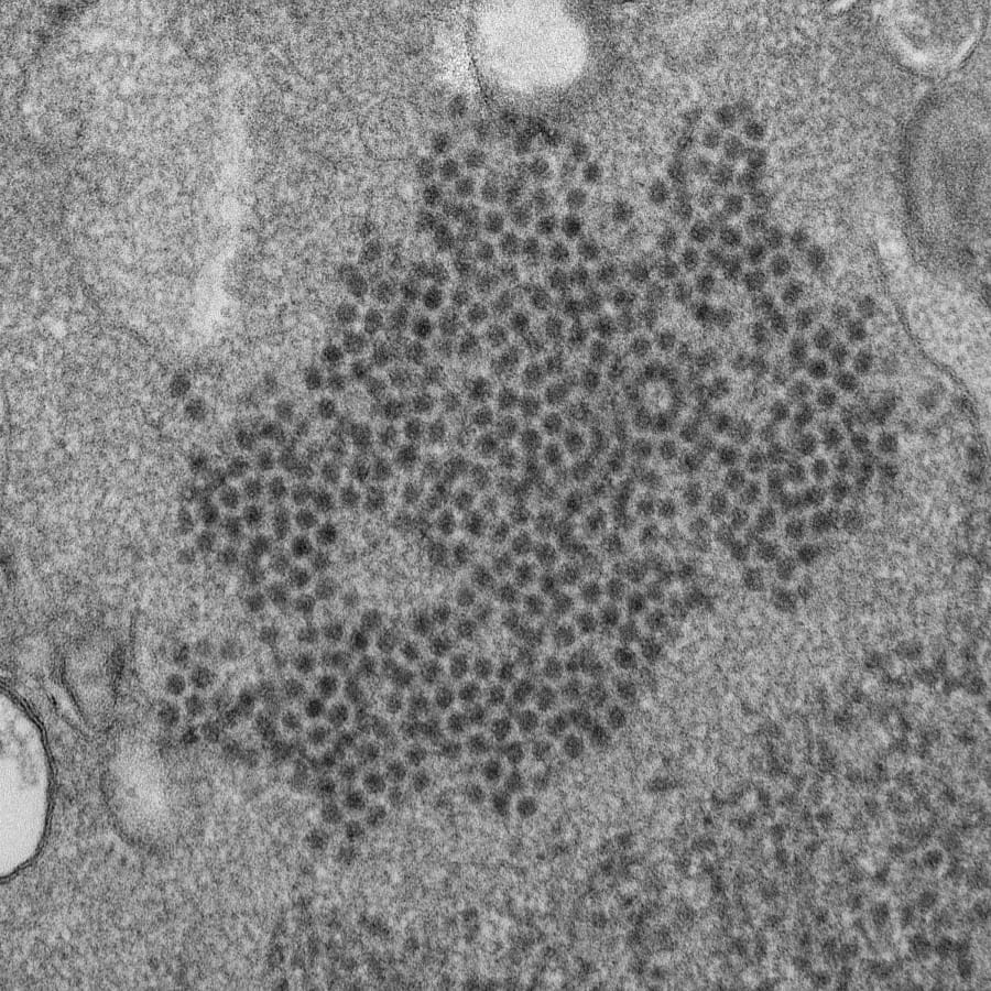 FILE - This 2014 file electron microscope image made available by the Centers for Disease Control and Prevention shows numerous, spheroid-shaped enterovirus-D68 (EV-D68) virions. Scientists have found the strongest evidence yet that a virus is to blame for a mysterious and rare illness, called acute flaccid myelitis or AFM, that can start like the sniffles but quickly paralyze children. University of California, San Francisco, researchers tested how the immune system fought back and found clear signs that an enterovirus, a common seasonal virus that specialists have suspected, was indeed the culprit. The the Centers for Disease Control and Prevention noted that AFM spikes coincided with seasons when certain strains of enteroviruses - EV-D68 and EV-A71 - were causing widespread respiratory illnesses.  (Cynthia S.