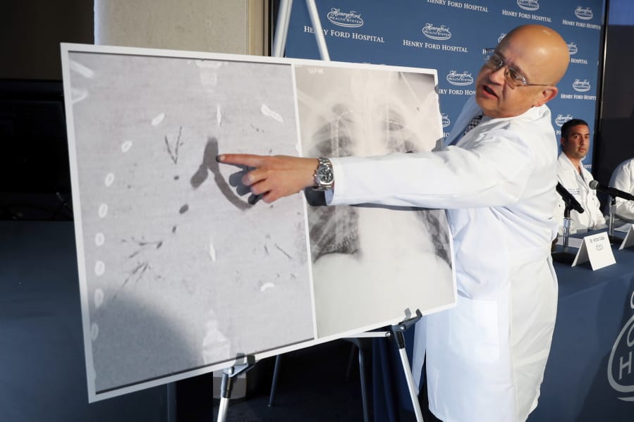 FILE - In this Tuesday, Nov. 12, 2019 file photo, Dr. Hassan Nemeh, surgical director of Thoracic Organ Transplant, shows areas of a patient&#039;s lungs during a news conference at Henry Ford Hospital in Detroit. A Henry Ford Health System medical team performed a double lung transplant for a patient whose lungs were irreparably damaged from vaping. On Friday, Dec. 20, 2019, the Centers for Disease Control and Prevention said vaping illnesses can get worse, even deadly, after patients leave the hospital and doctors should check on patients within two days of sending them home.