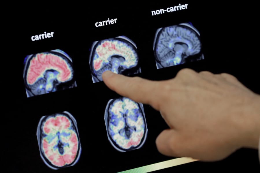 FILE - In this Aug. 14, 2018 file photo, a doctor looks at a PET brain scan at the Banner Alzheimers Institute in Phoenix. Two experimental drugs failed to prevent or slow mental decline in a study of people who are virtually destined to develop Alzheimer&#039;s disease at a relatively young age because of rare gene flaws. The results announced Monday, Feb. 10, 2020, are another disappointment for the approach that scientists have focused on for many years -- trying to remove a harmful protein that builds up in the brains of people with the disease.