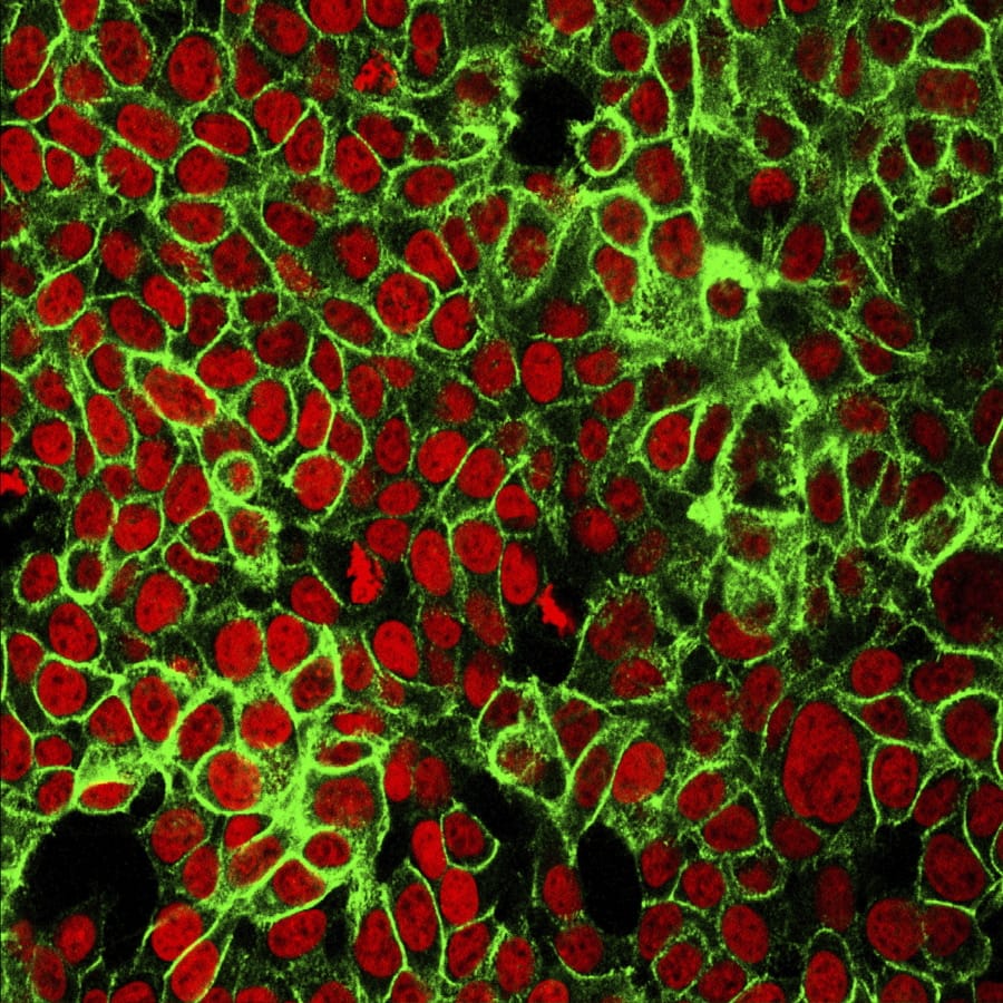 This microscope image made available by the National Cancer Institute Center for Cancer Research in 2015 shows human colon cancer cells with the nuclei stained red. On Friday, May 29, 2020, doctors are reporting success with newer drugs that control certain types of cancer better, reduce the risk it will come back and make treatment simpler and easier to bear.