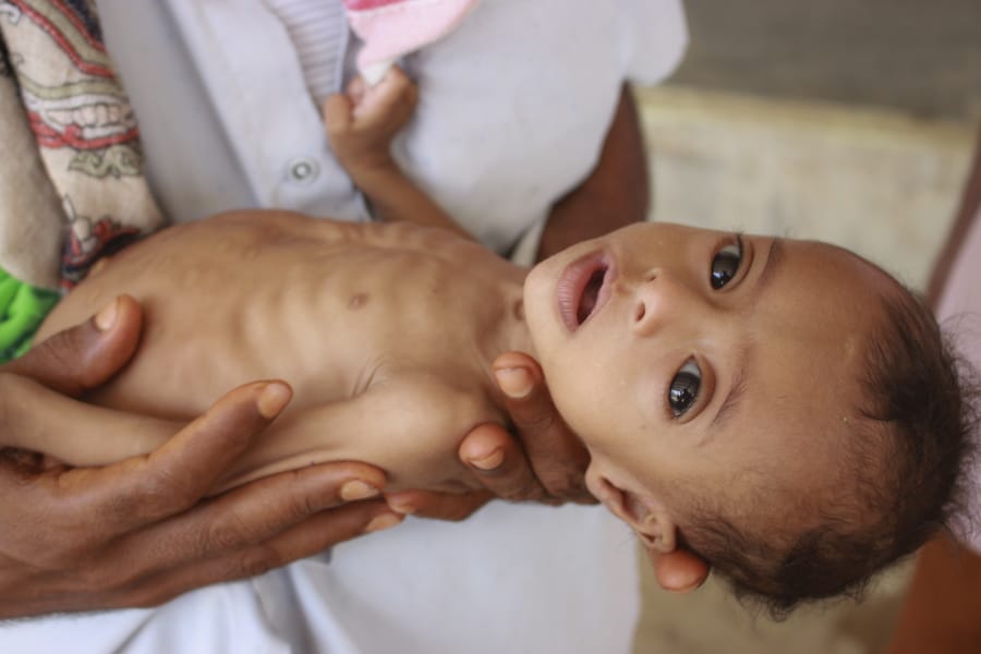 In this Sunday, June 14, 2020 photo, seven-month-old Issa Ibrahim Nasser is brought to a clinic in Deir Al-Hassi, At seven months old, Issa weighs only three kilos. Like him, hundreds of children suffer from acute severe malnutrition because of poverty and grinding conflict. Yemen.