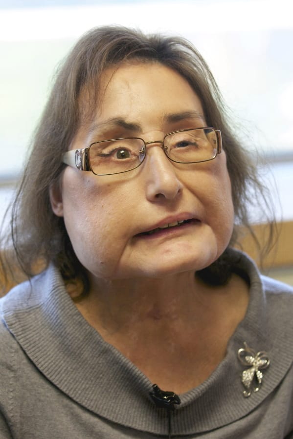 Connie Culp, the nation&#039;s first partial face transplant recipient, speaks Sept. 14, 2010 with the Associated Press at the Cleveland Clinic in Cleveland.