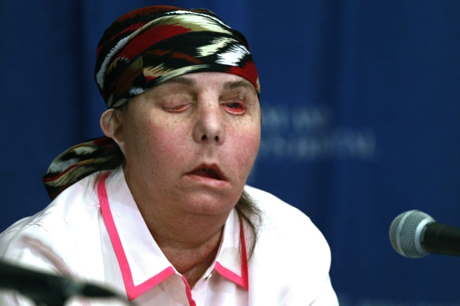 FILE - In this May 1, 2013, file photo, Carmen Blandin Tarleton speaks at Brigham and Women&#039;s Hospital in Boston following a face transplant. In February 2007 her estranged husband doused her with industrial strength lye, burning more than 80 percent of her body. In July 2020, Tarleton became the first American and only the second person globally to undergo a second face transplant procedure after her first transplant failed.