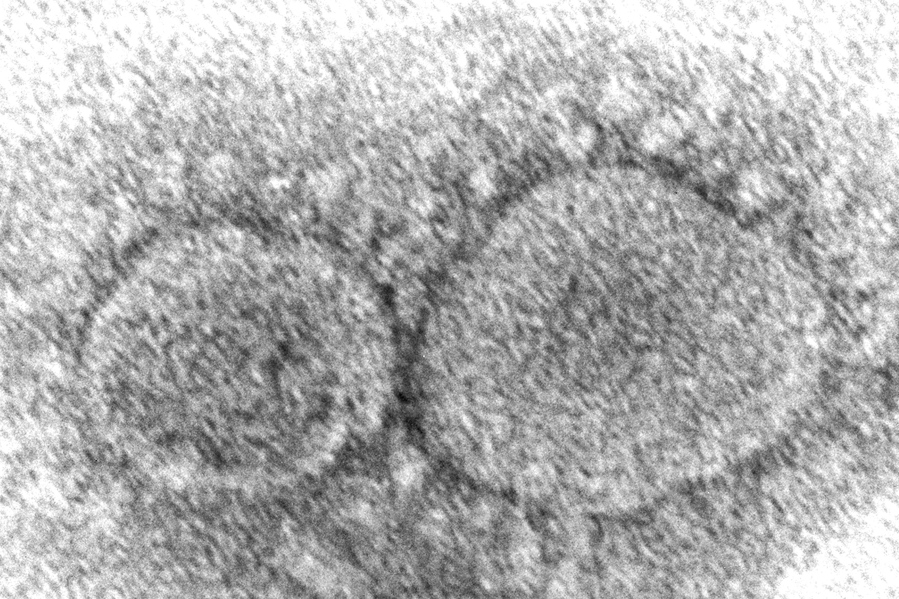 This 2020 electron microscope image made available by the Centers for Disease Control and Prevention shows SARS-CoV-2 virus particles which cause COVID-19. According to research released in 2021, evidence is mounting that having COVID-19 may not protect against getting infected again with some of the new variants. People also can get second infections with earlier versions of the coronavirus if they mounted a weak defense the first time. (Hannah A.