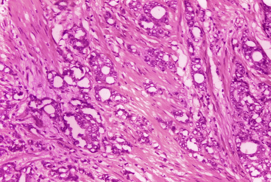 This 1974 microscope image made available by the Centers for Disease Control and Prevention shows changes in cells indicative of adenocarcinoma of the prostate. In results released Thursday, June 3, 2021 by the American Society of Clinical Oncology, doctors are reporting improved survival in men with advanced prostate cancer from an experimental drug that delivers radiation directly to tumor cells. (Dr. Edwin P.